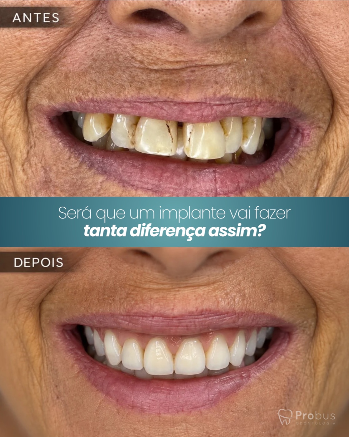 Post: Será que um implante vai fazer tanta diferença assim? — antes e depois